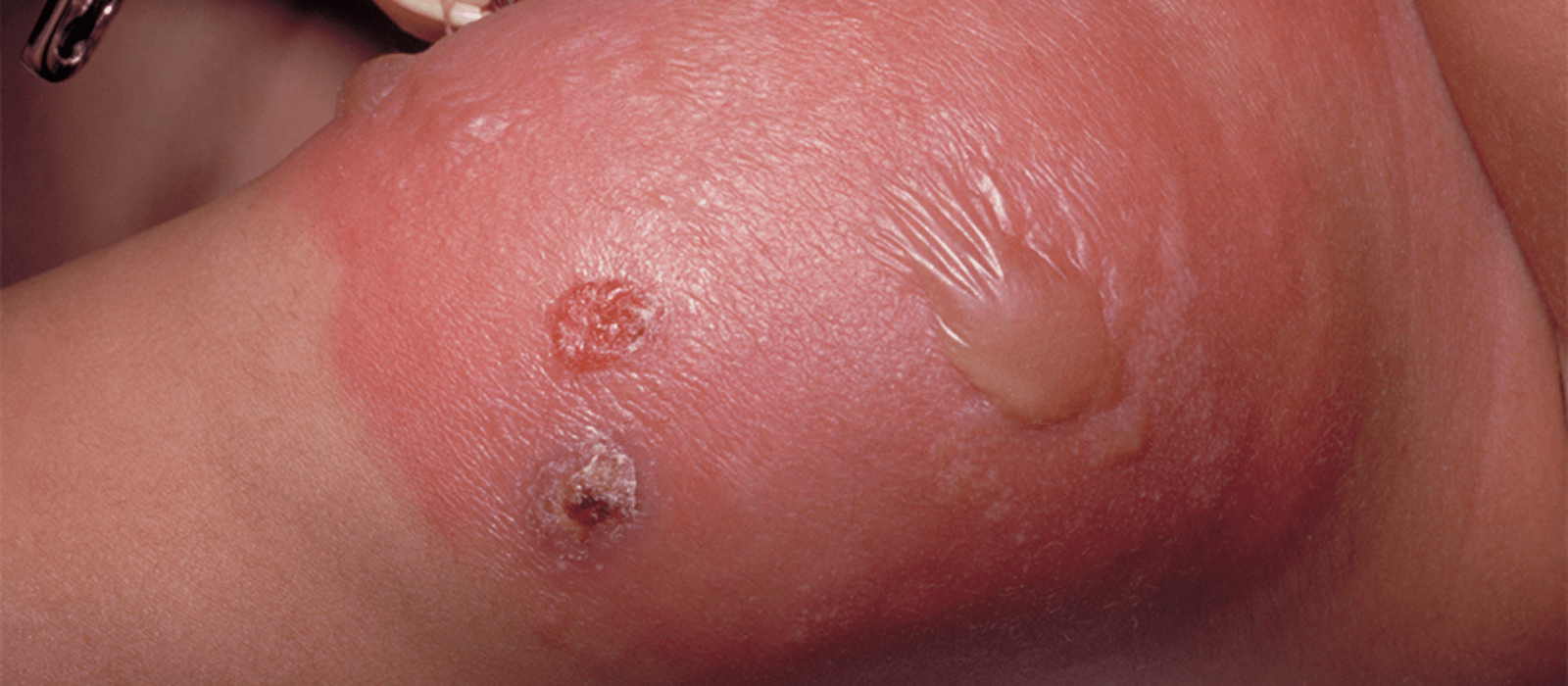 close up of caucasian with cellulitis
