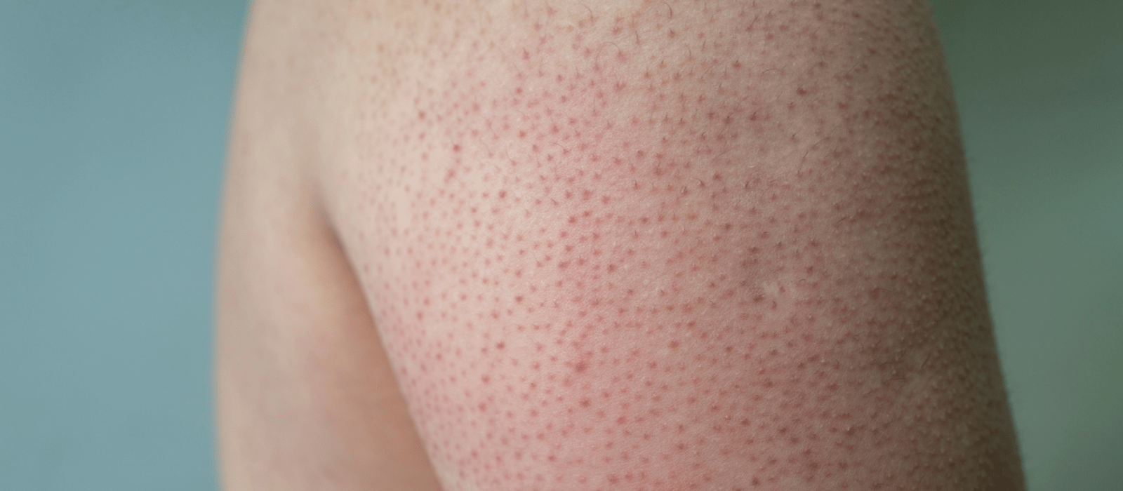 Keratosis Pilaris on mans arm