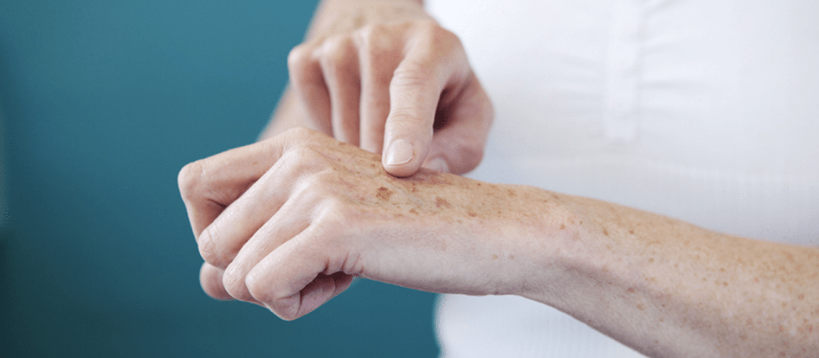lentigines on hands