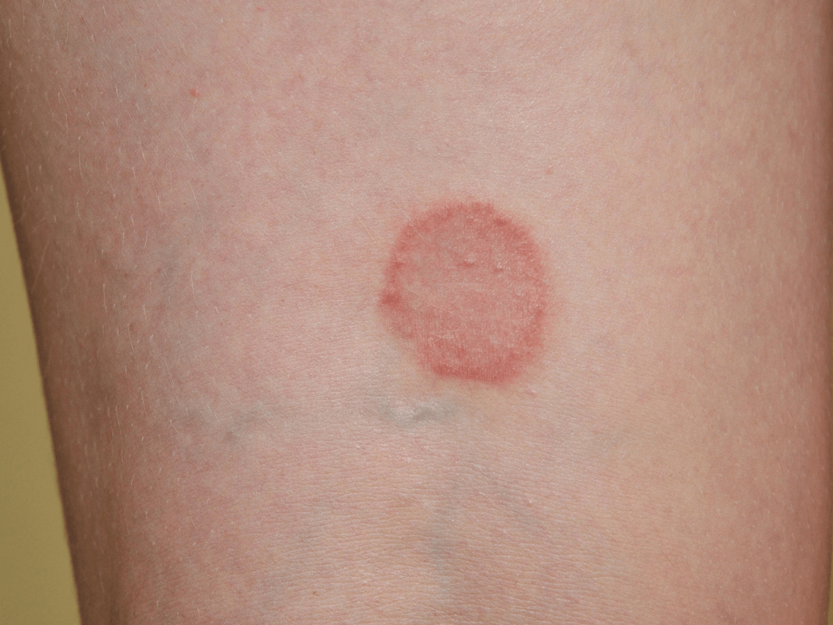 Lichen Planus ring on stomach