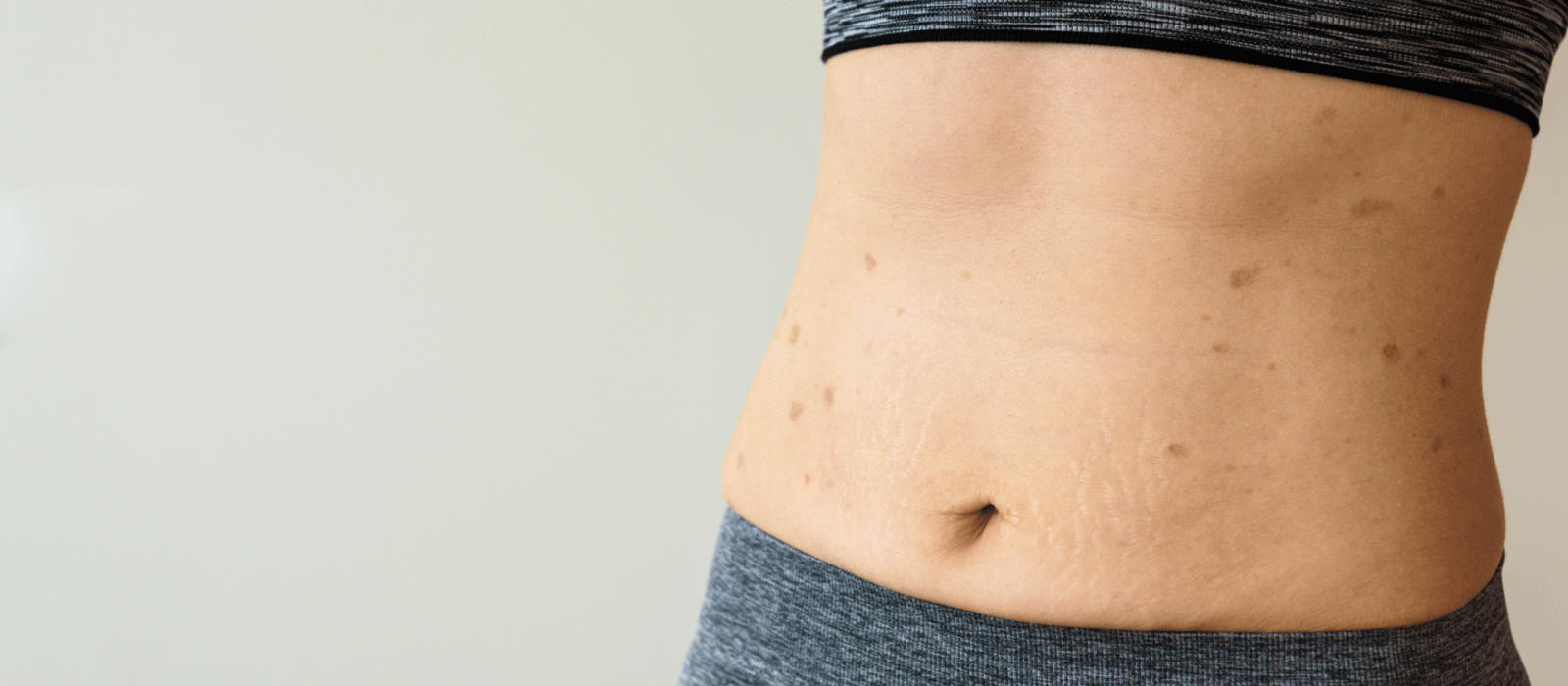 Lichen Planus on stomach