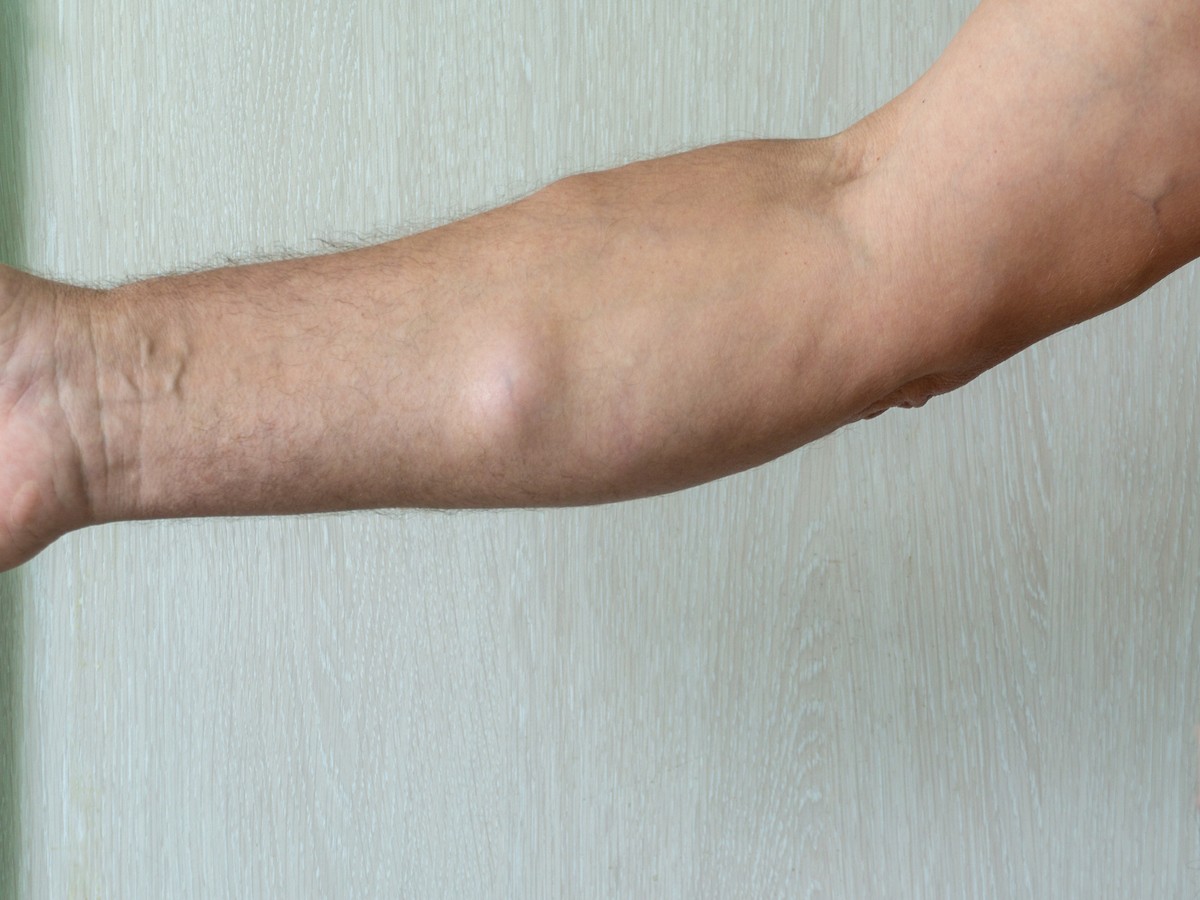A man with lipomas - benign tumors on the body. multiple lipomas