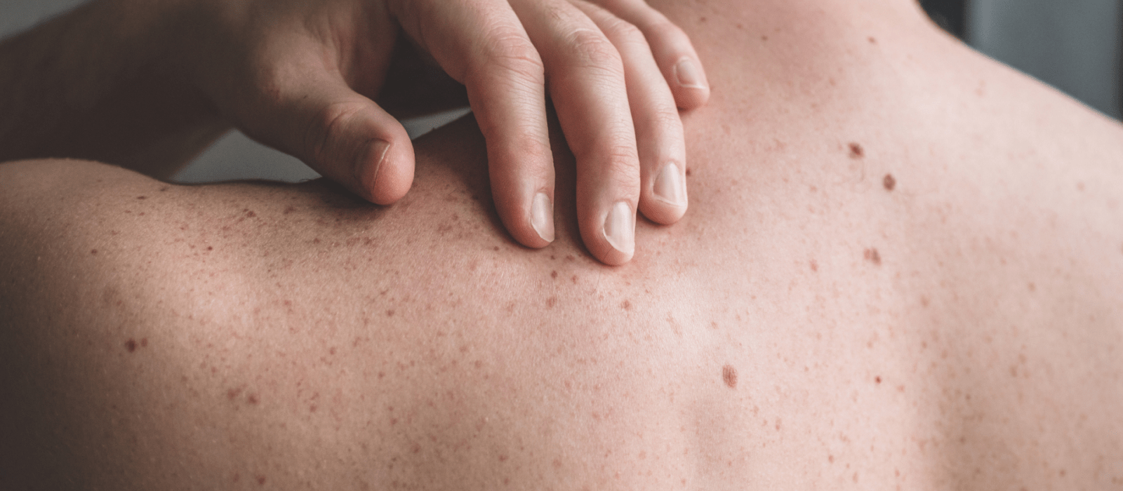 Moles - Virginia Dermatology &amp; Skin Cancer Center