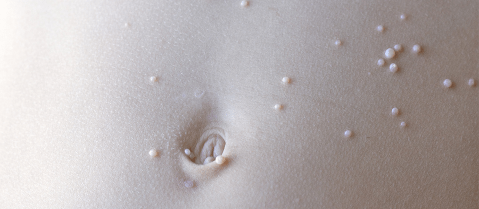 close up of Molluscum Contagiosum on abdomen