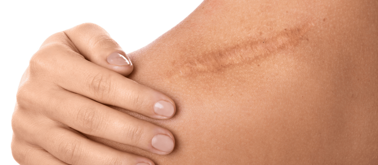 scar on a womans shoulder