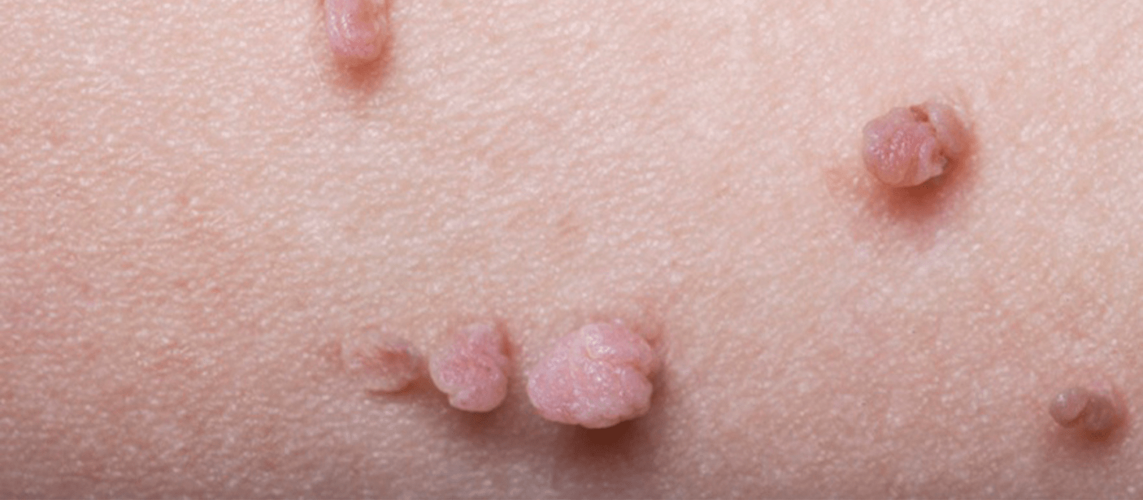 Close up of skin tags
