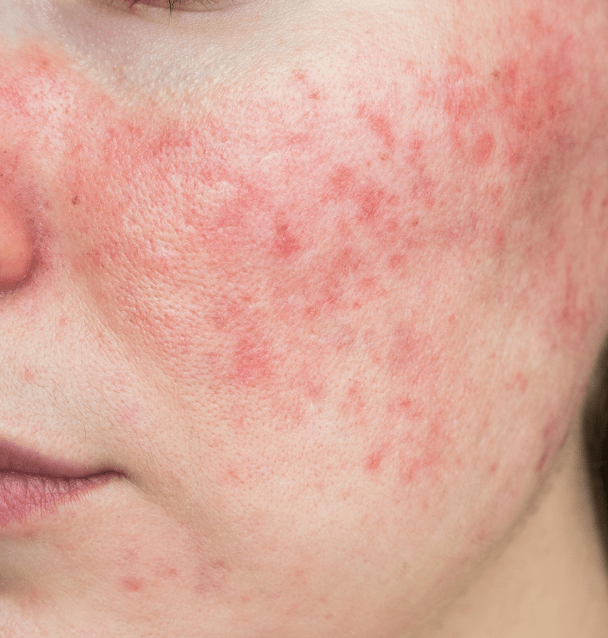 acne on womans cheek