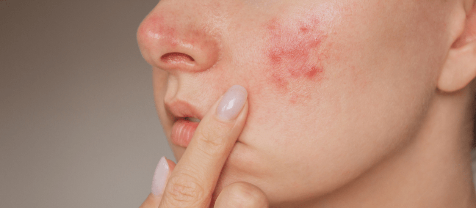 Acne - Virginia Dermatology & Skin Cancer Center