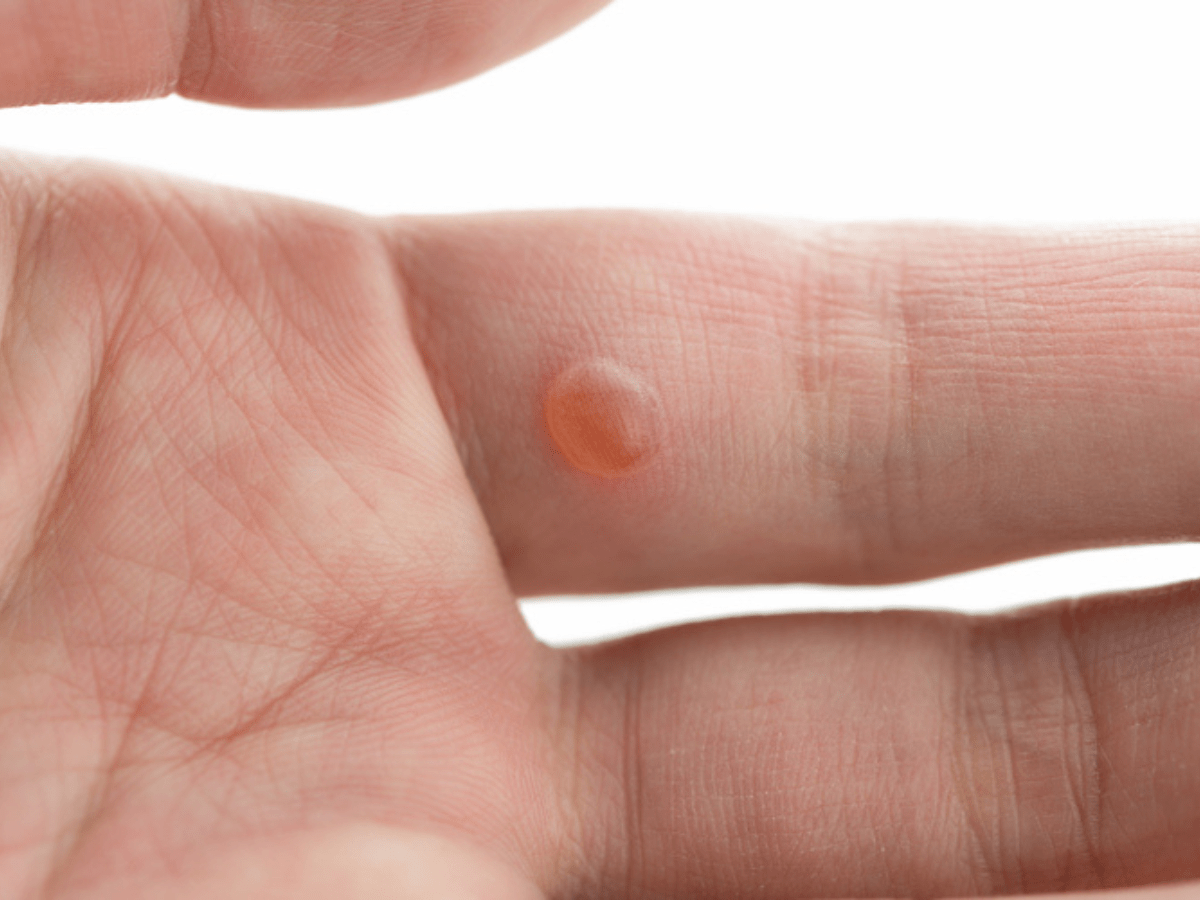 wart on hand