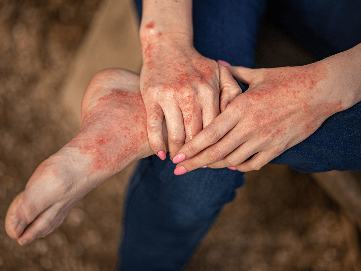 contact dermatitis on hands and feet