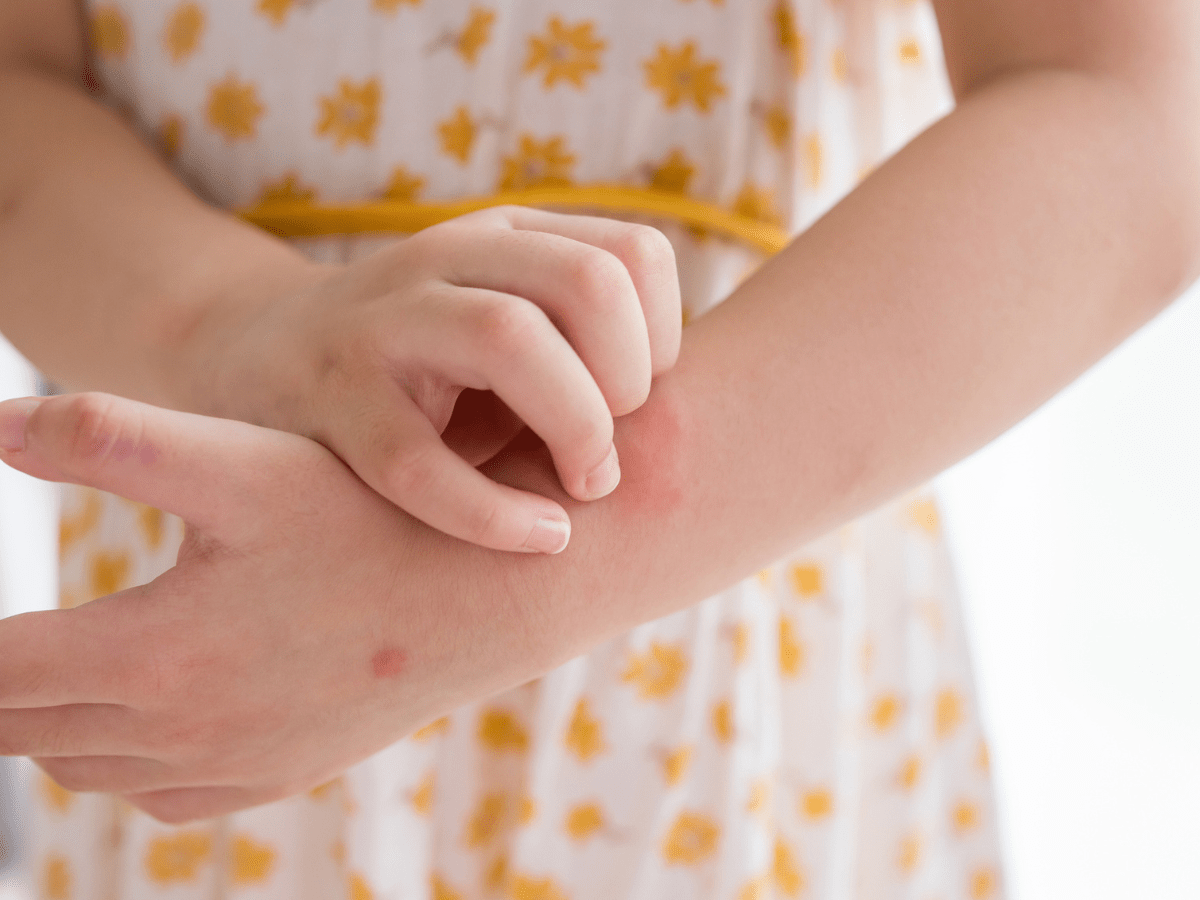 treatment for contact dermatitis