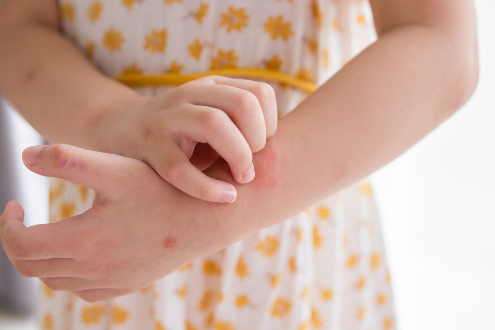 young girl with a rash on her wrist