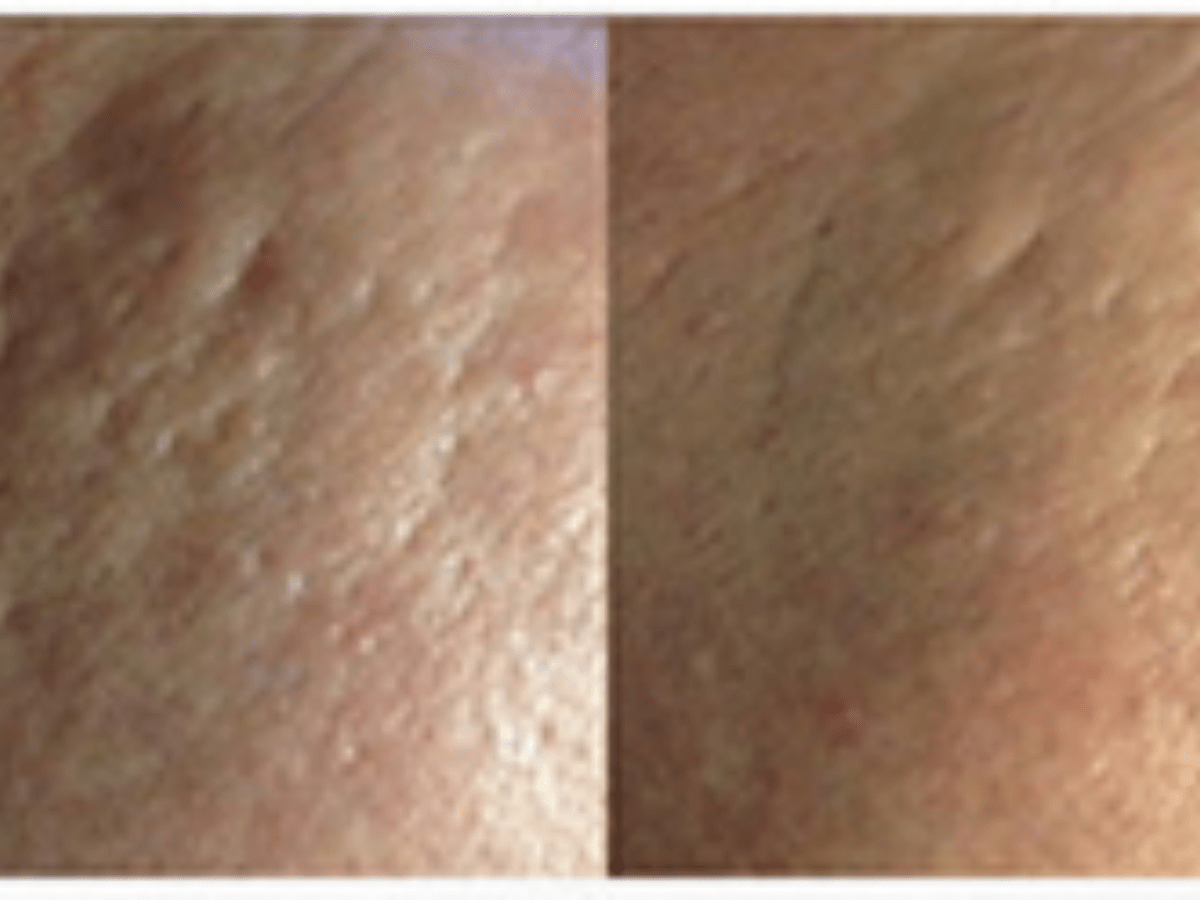 microneedling