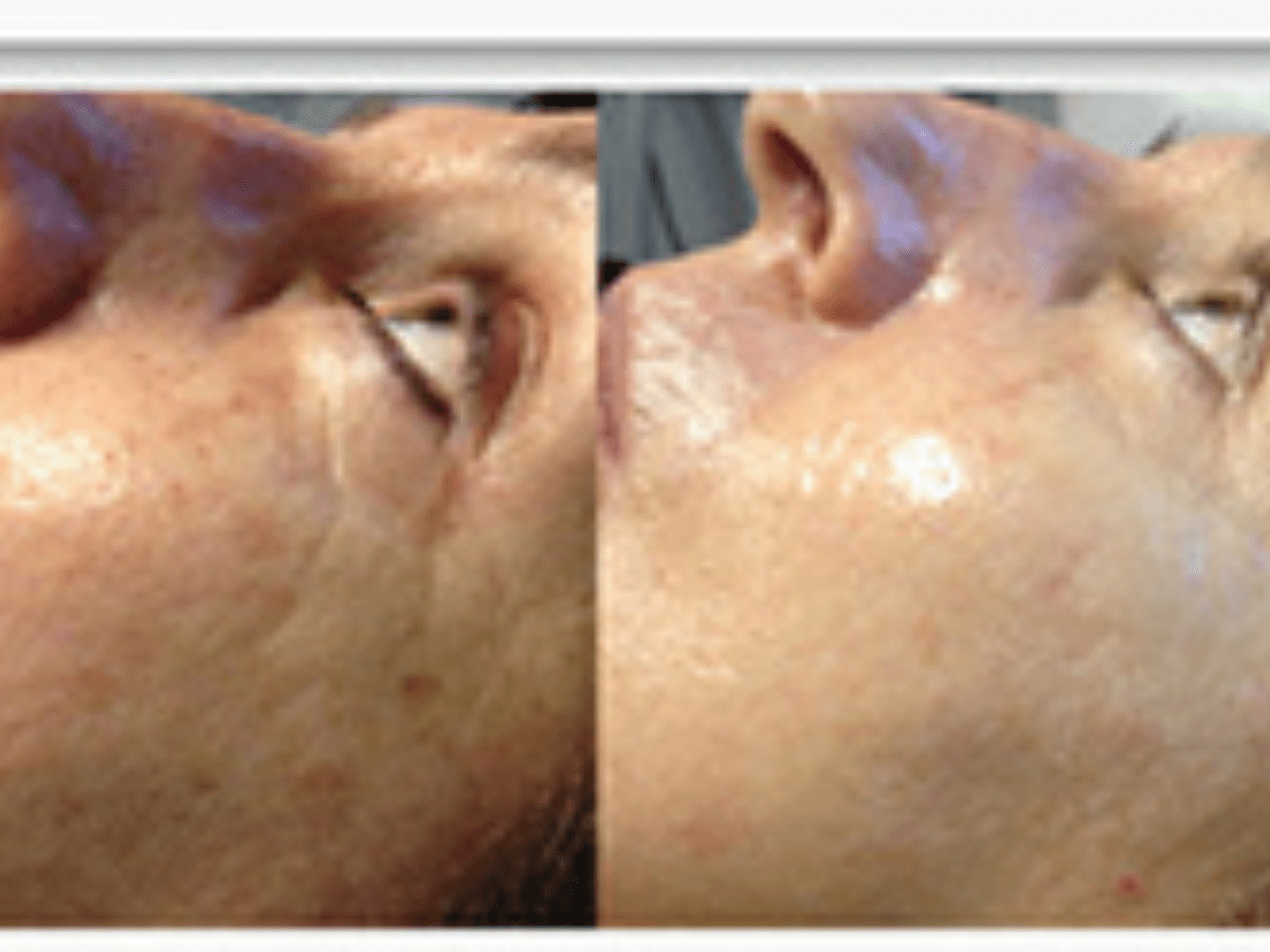 microneedling