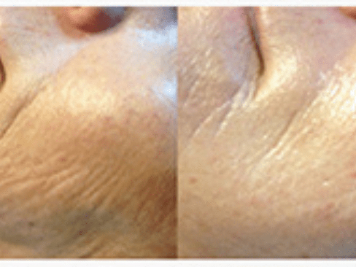 microneedling