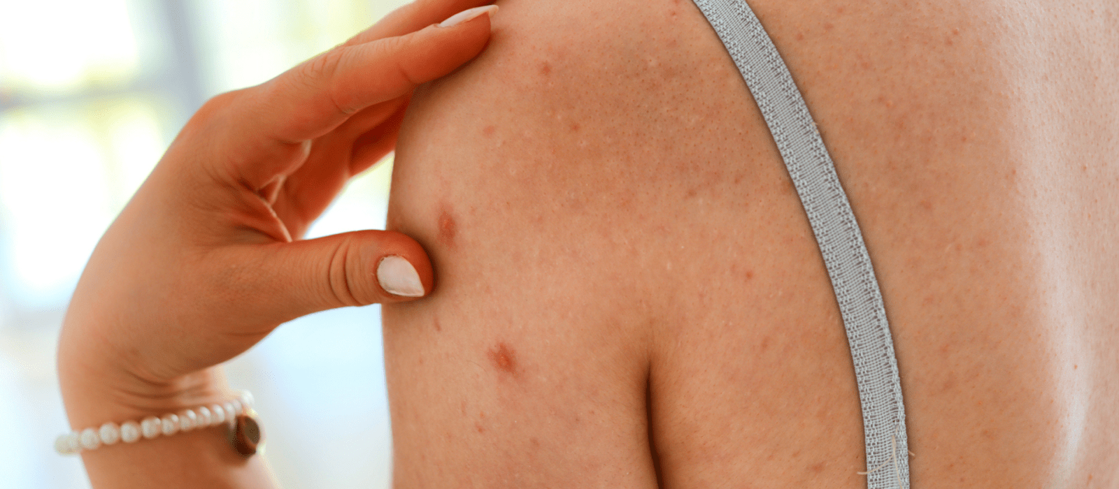 shingles on womans back