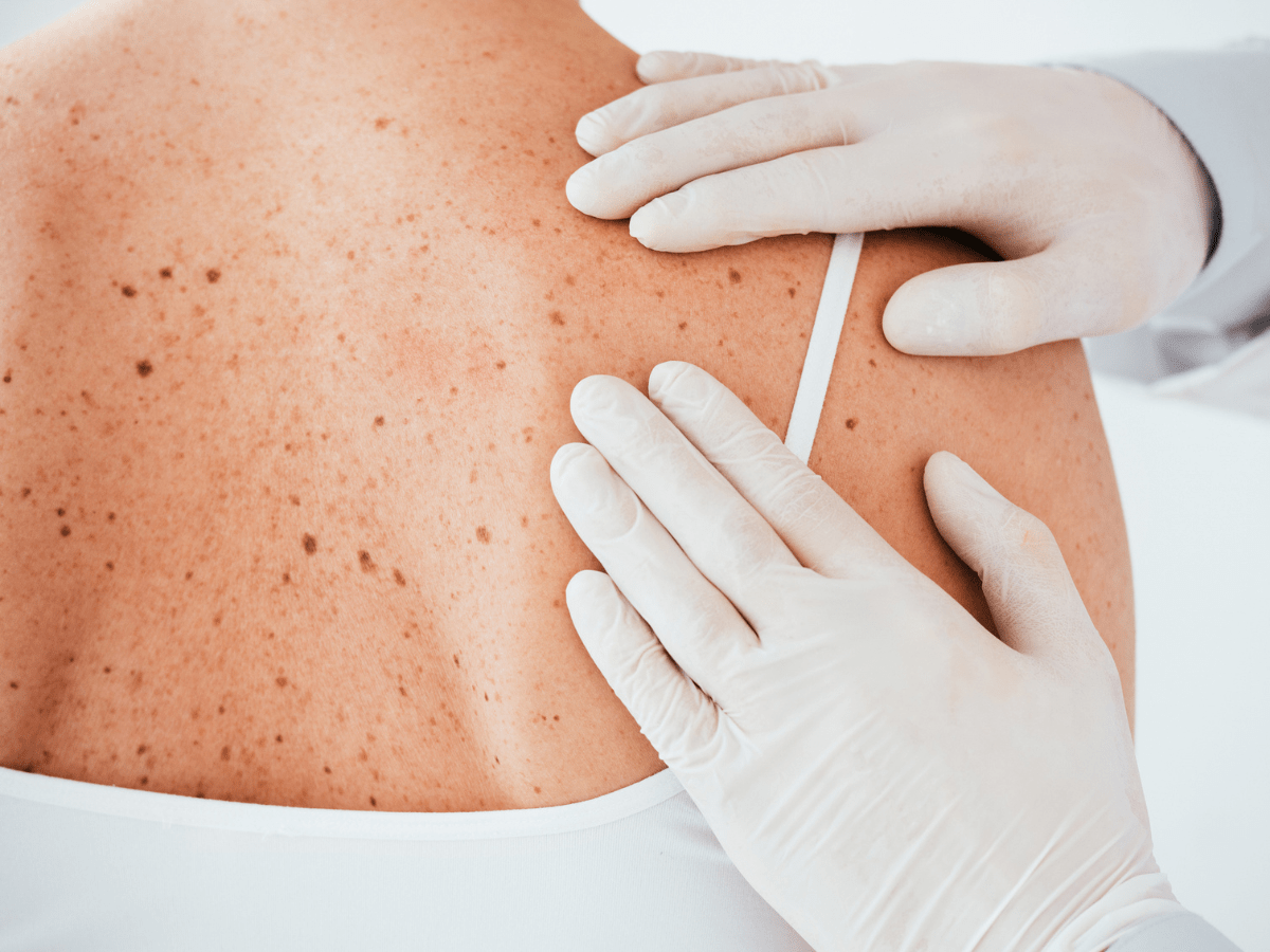 moles on someone's back