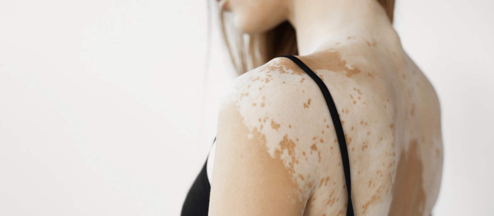 woman with vitiligo on her back
